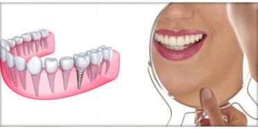 Implantologia Dentale carico immediato