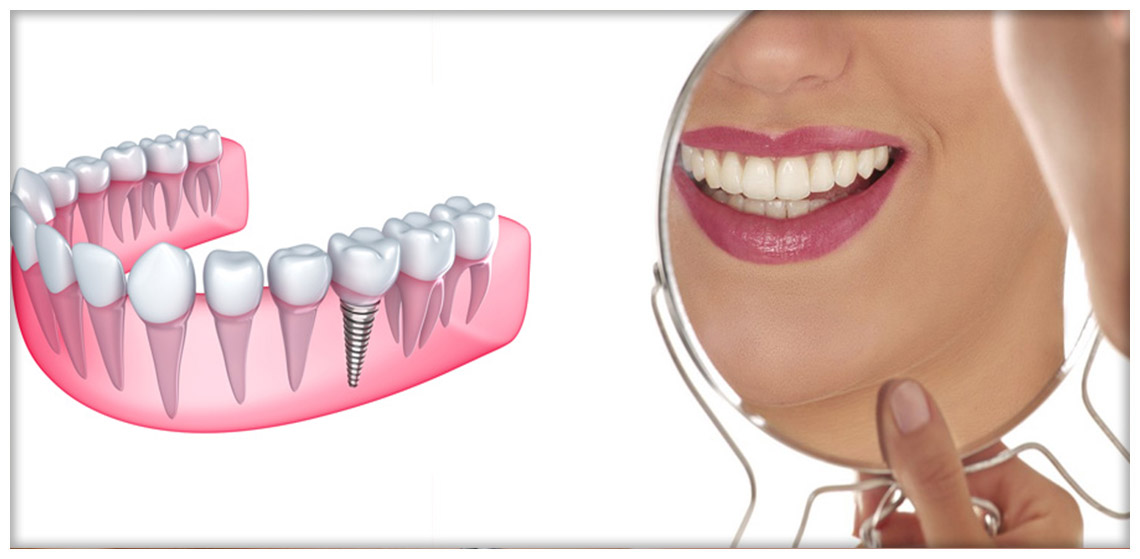 Implantologia Dentale carico immediato