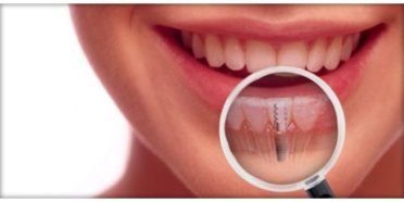 implantologia Dentale